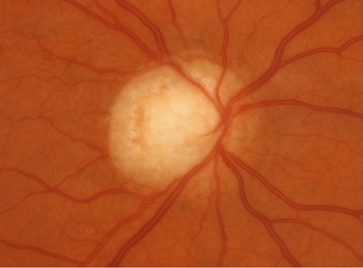 Nahaufnahme der menschlichen Netzhaut, die in der Mitte den Sehnervenkopf mit ausstrahlenden Blutgefäßen zeigt - eine wichtige Ansicht in der Sehdiagnostik, die ein Augenarzt zur Beurteilung von Erkrankungen wie Katarakt auf der orange-roten Netzhautoberfläche verwenden könnte.